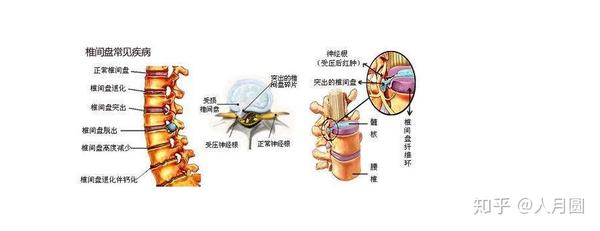 腰间盘突出民间偏方大全