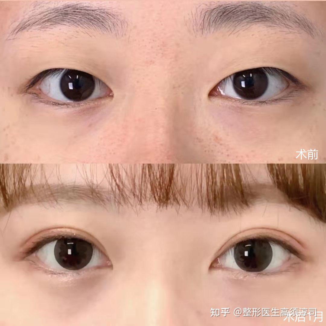 什么样的眼睛适合做埋线和开眼角?