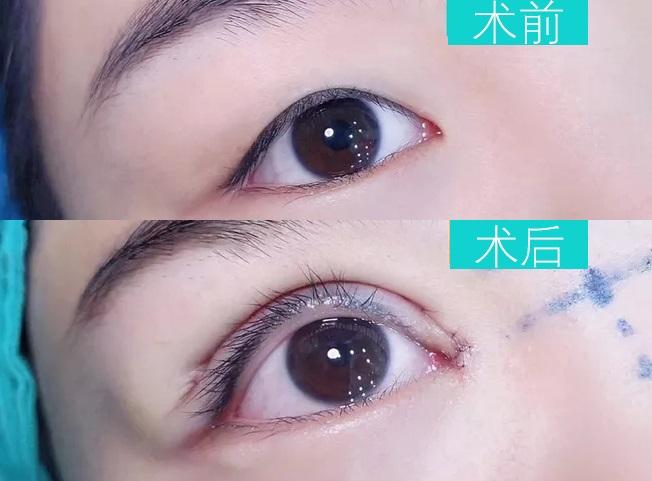 8mm开扇形双眼皮图片,双眼皮7mm和8mm效果图 目前双眼皮的几种形态:扇形(开扇,平扇),平行形,欧美型和新月形