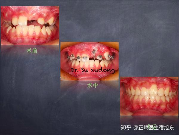 处理:拔除多生牙,开窗牵引牙齿萌出. 3.