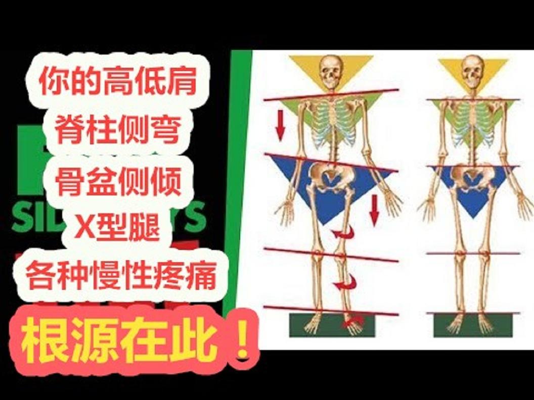 你的高低肩脊柱侧弯骨盆侧倾x型腿根源很可能在此