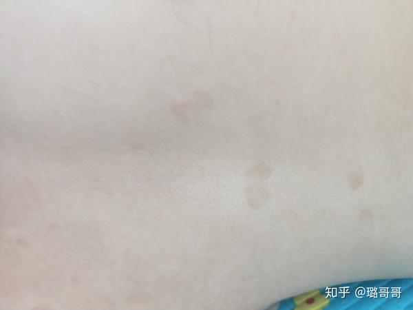 身上起了这样红色的斑是怎么回事