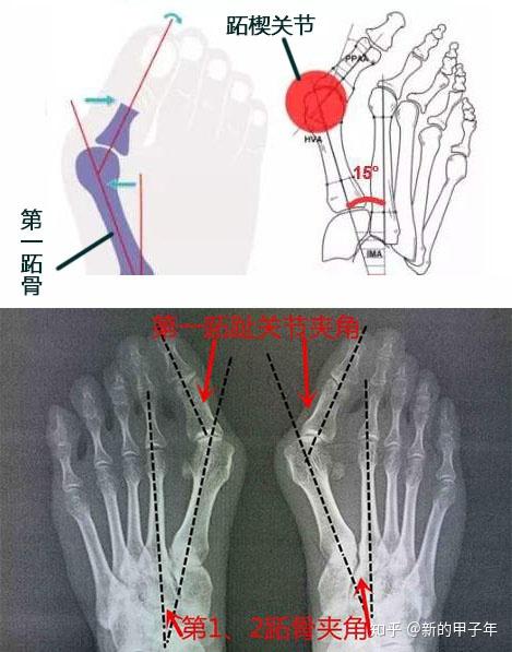 拇外翻是脚趾在 第一跖趾关节处向外侧偏斜移位.