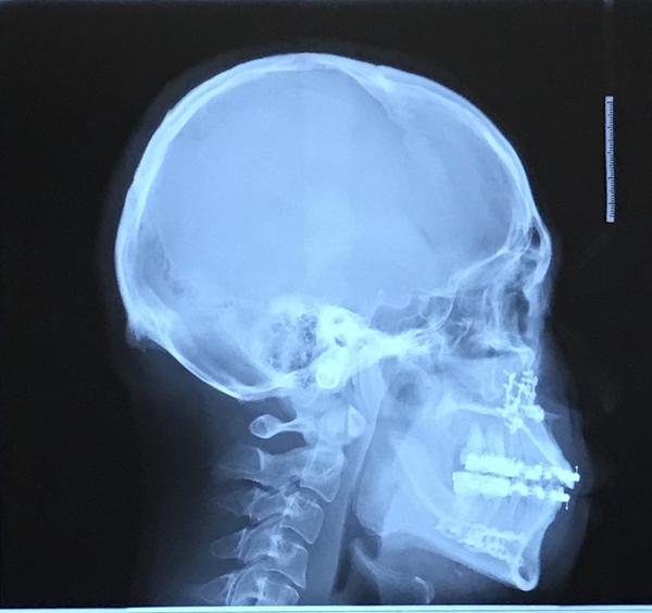 给你们看一下我术后的x光片吧 让你们有个直观的印象 我上下颌都动了