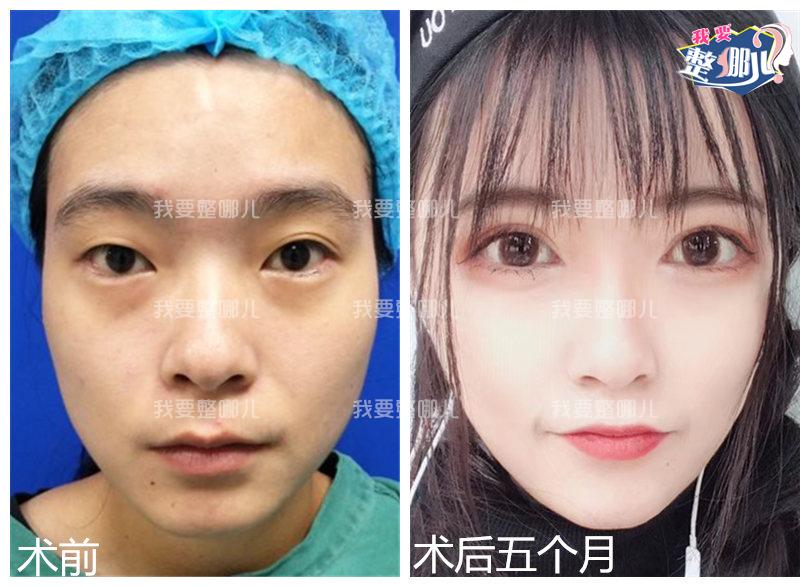 眼睛一单一双,只做一只眼可以吗?