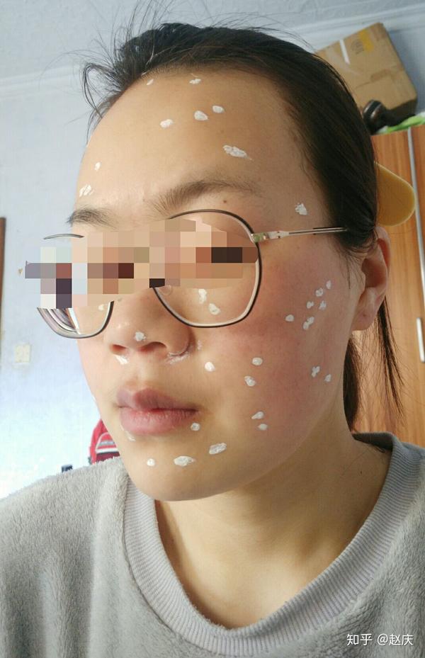今天是祛痣的第18天,有些小的开始变得不太明显.