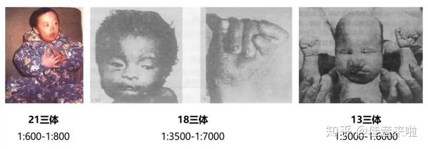 5万例的数目增长,每年因21-三体综合征造成的经济损失超过20亿元,给
