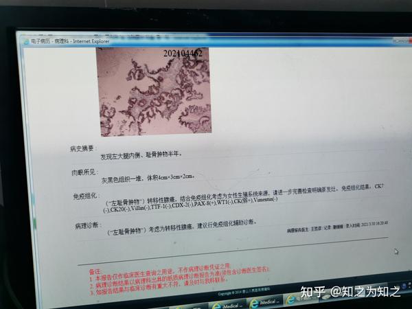 子宫内膜癌,4b,骨转移,大腿近端转移
