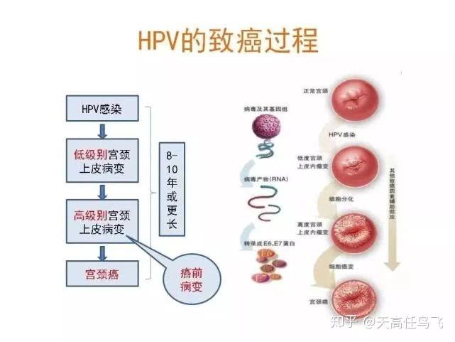 绝经后不会的宫颈癌了派特生物告诉你真相