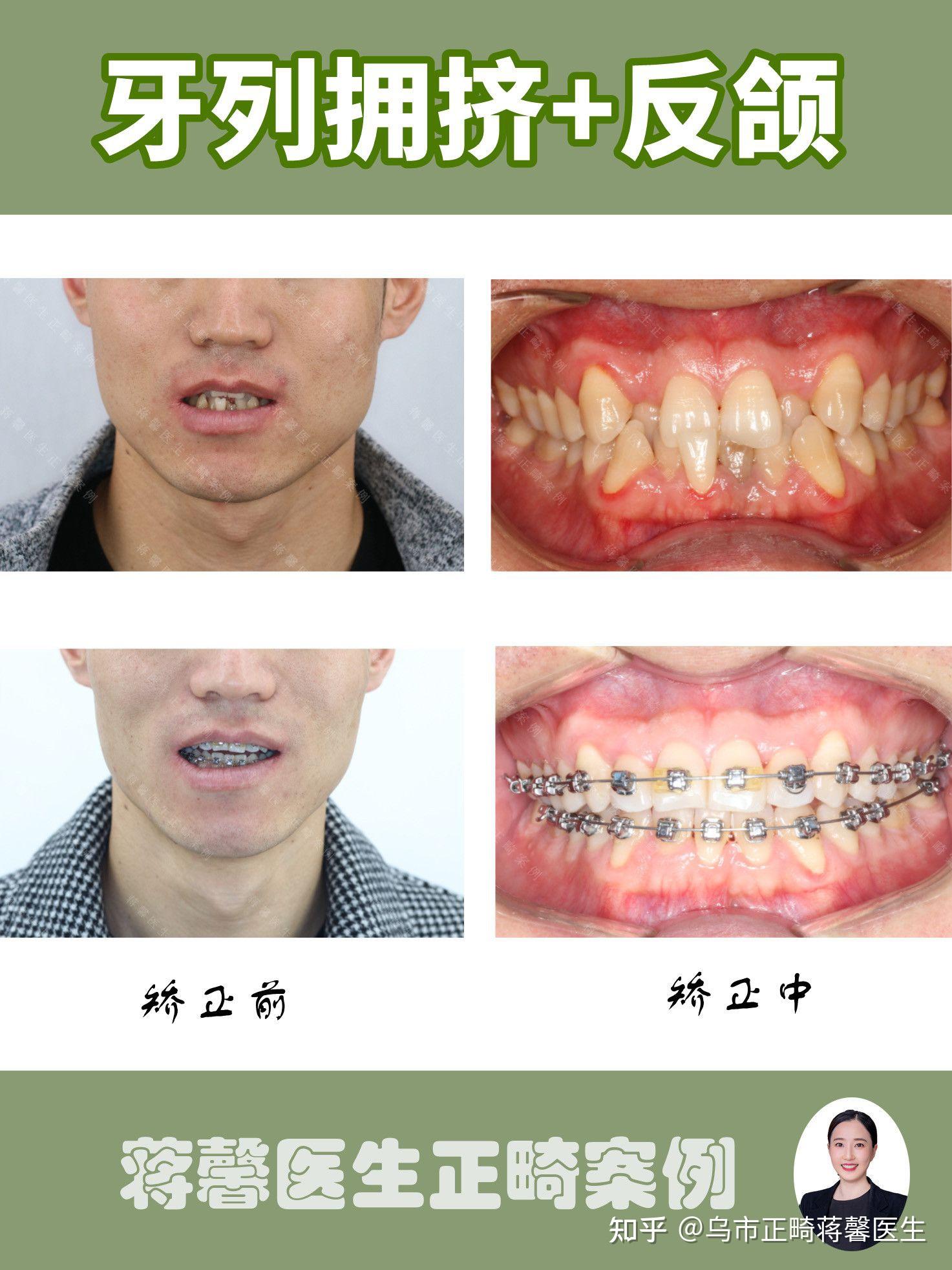 不拔牙矫正案例牙列拥挤反颌