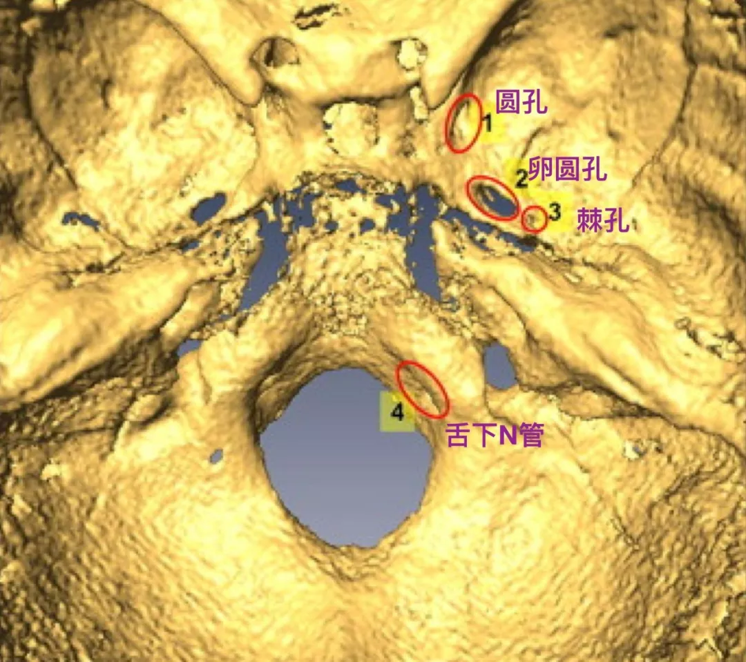 伴颅中窝骨折累及棘孔为例,显示棘孔的位置