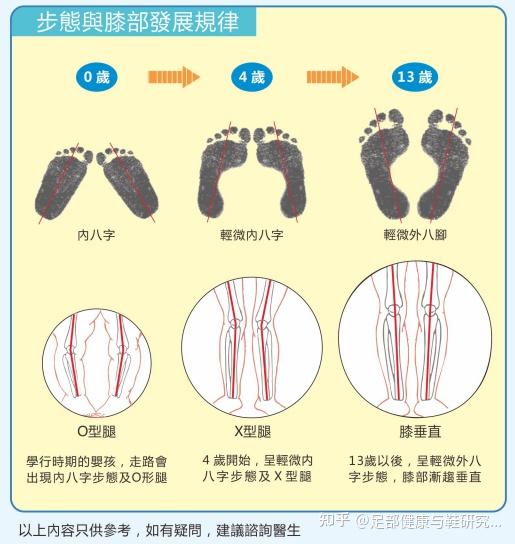 家长应该了解的儿童下肢发育现象扁平足足外翻o型腿