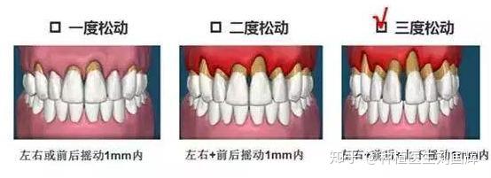 牙齿松动别急着拔!这3个对策分分钟可以搞定松动牙