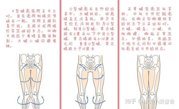 xo型腿是怎么形成的xo型腿该如何矫正