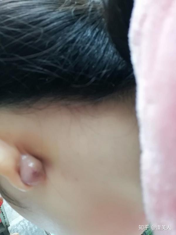打耳洞感染长了一个圆疙瘩,已经好了(没割)希望对同症状的姐妹有用