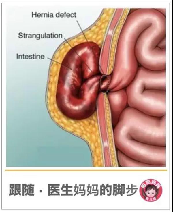 "脐疝"会不会出现意外?