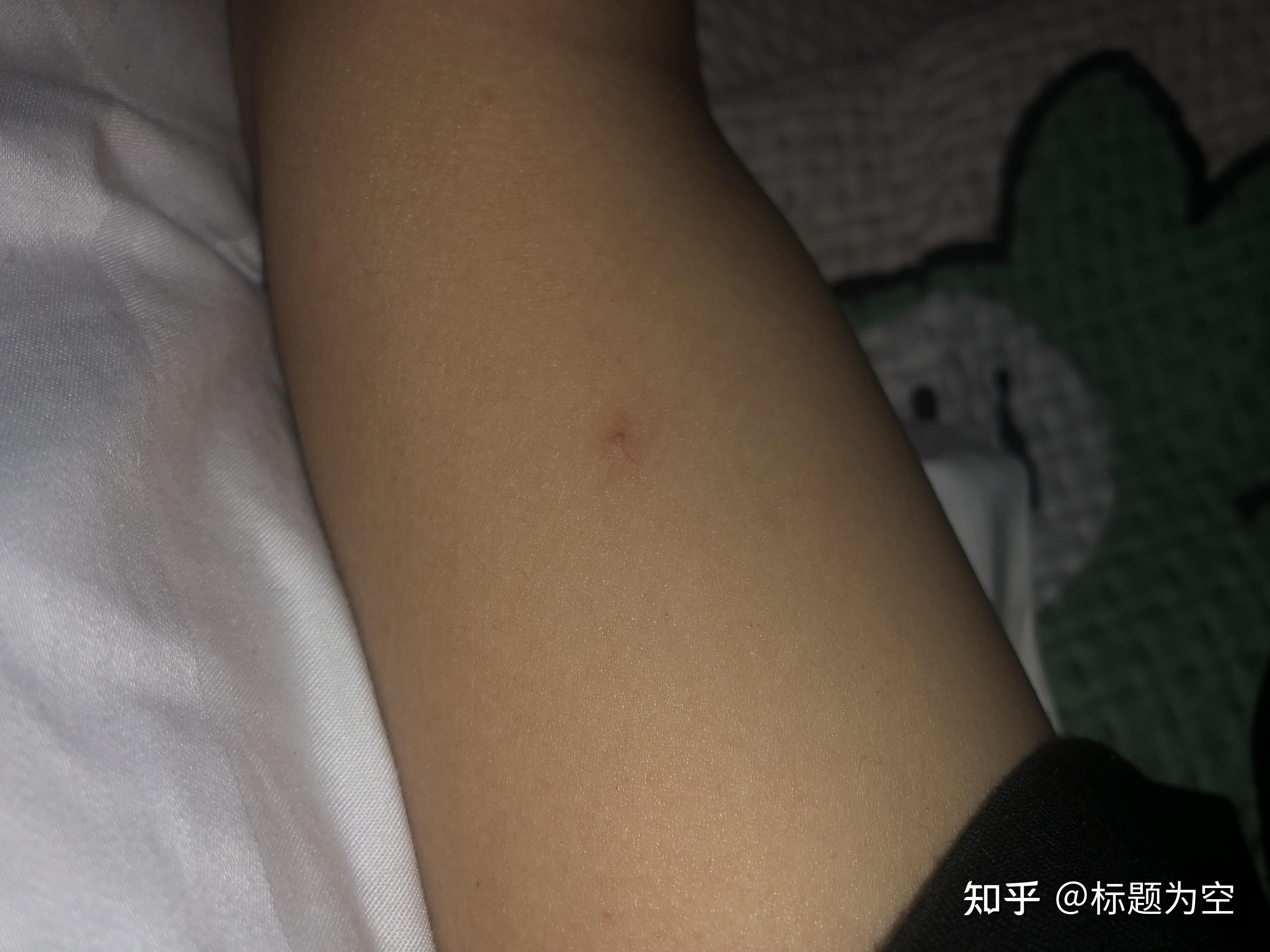 这是蜘蛛痣吗