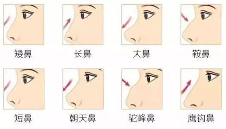 范芳医生谈国人常见鼻型及美学特点一