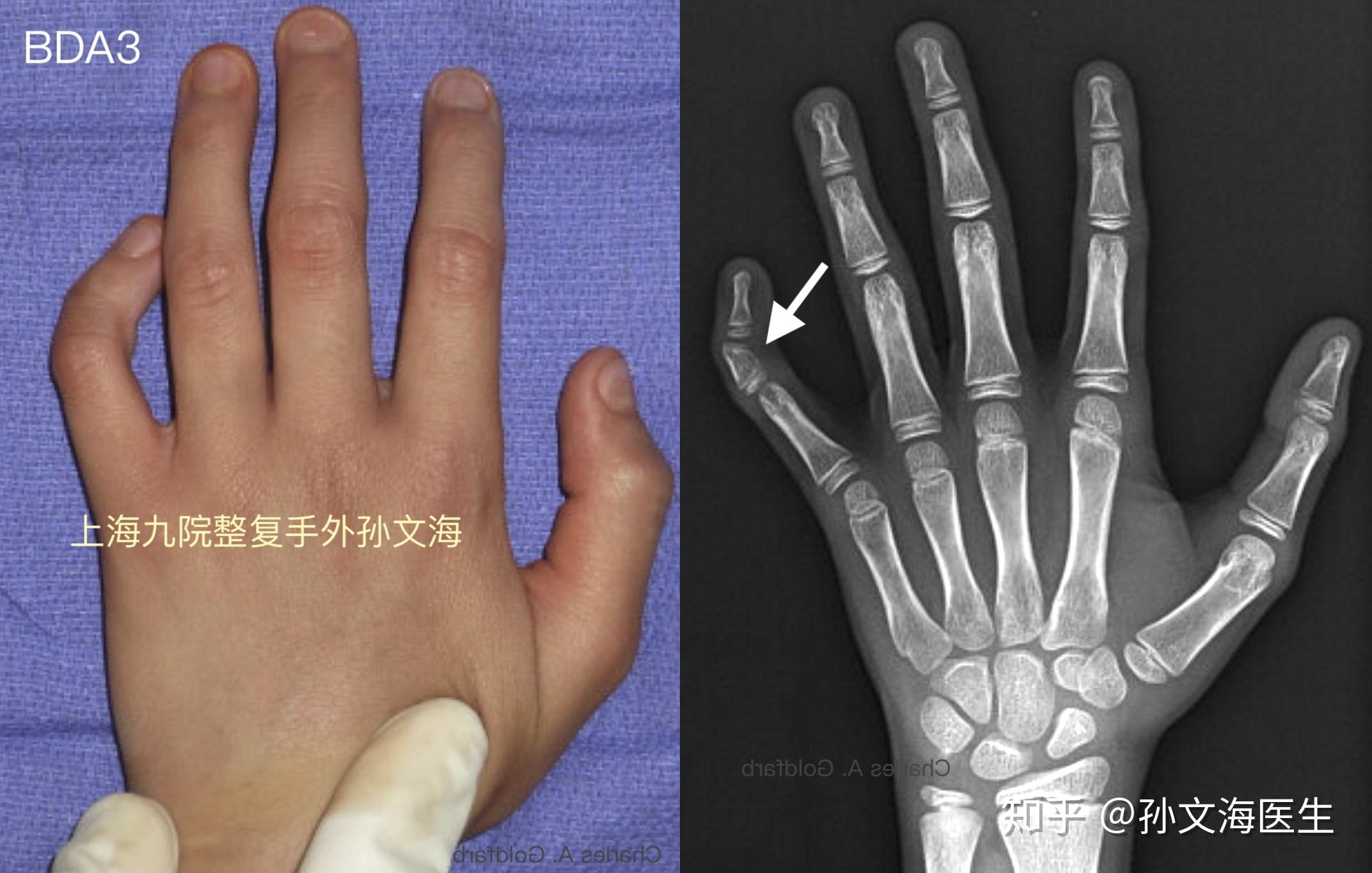 掌骨短小,指骨长度正常(e1 第四跖骨短小症)d 拇指远节指