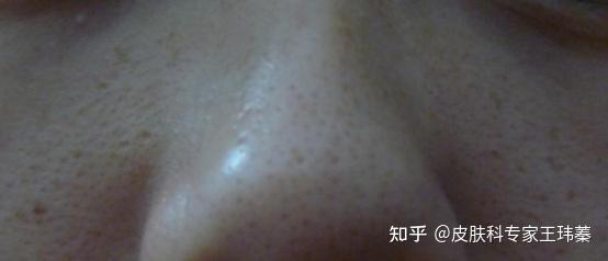 你知道毛孔粗大是怎么回事吗