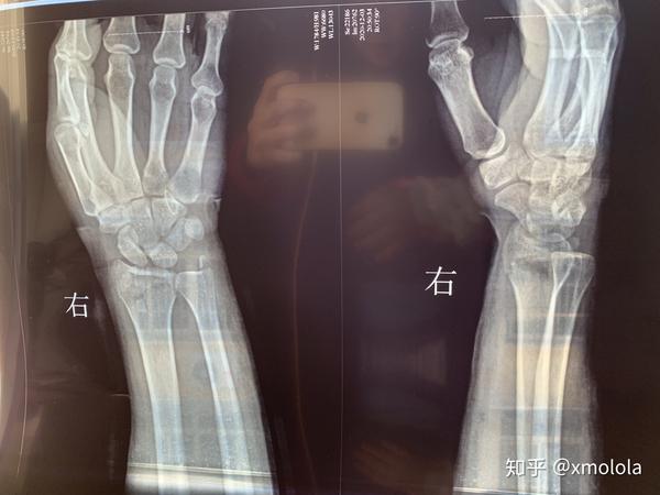 右尺桡骨远端骨折,中医表姐手法复位治疗记(二)图片