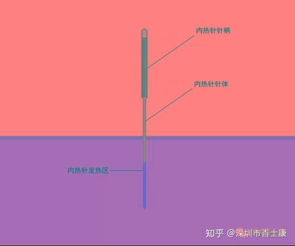 筋膜学内热针新技术