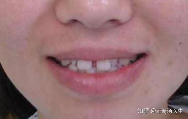 31岁宝妈牙齿缝隙变大,竟是"它"惹的祸