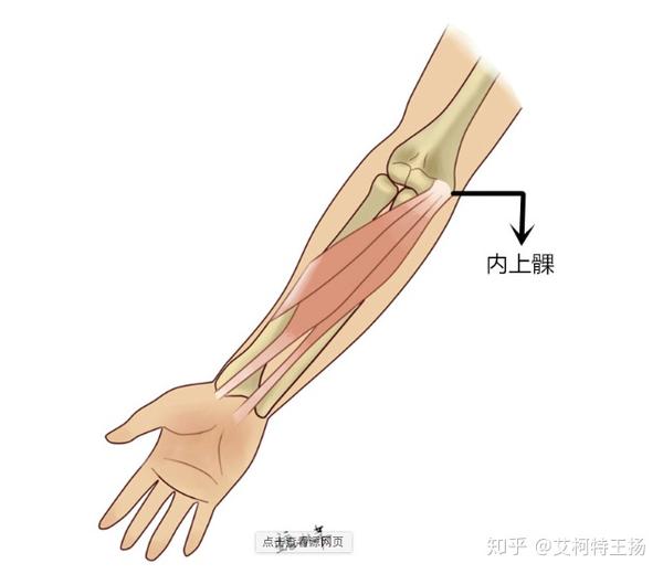 此病为内上髁肌腱附着点,神经及韧带组织发生退变导致的肱骨内上髁