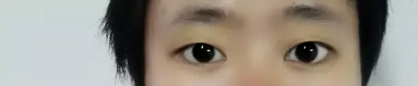 1.单眼皮眼型