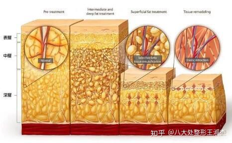 皮下脂肪通常分为三层:皮下固有脂肪层,浅层脂肪层,深层脂肪层.