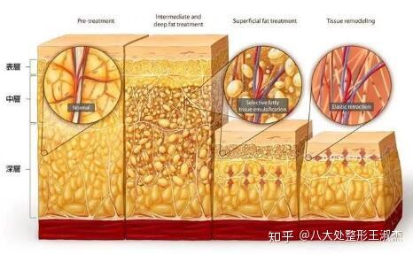 深浅层脂肪示意图