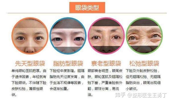 其实眼袋大致可以分为:水肿型眼袋,脂肪膨出型眼袋,泪沟型眼袋