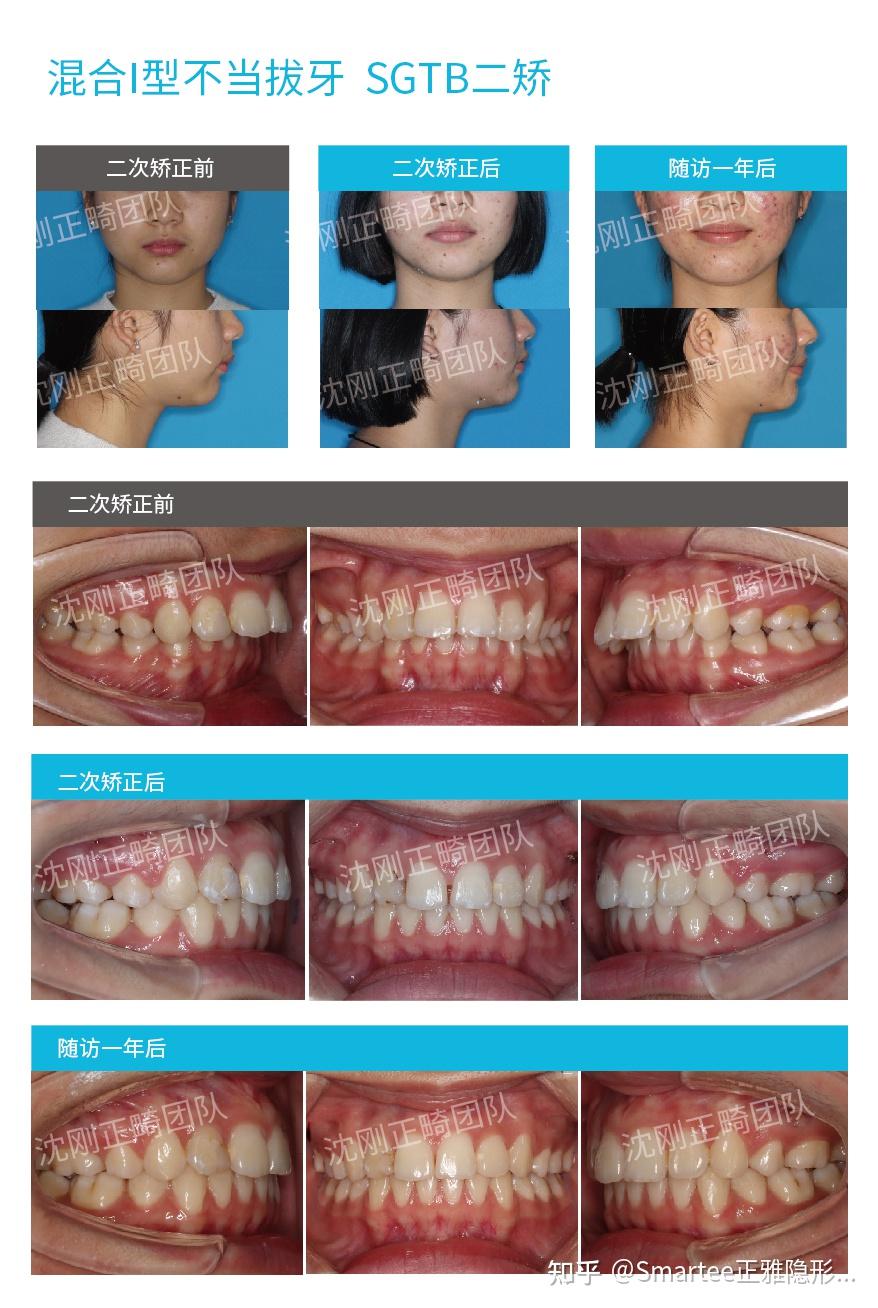 下图为沈刚正畸团队为某混i病例使用sgtb进行二矫时口内口外对比照