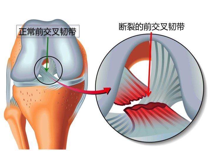 前交叉韧带重建术后康复指导中期术后5周12周强化肌力康复阶段及后期