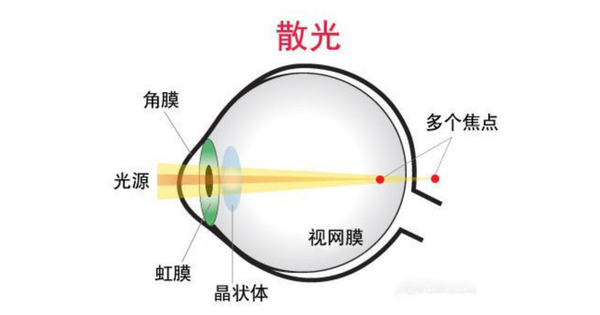 眼睛散光是怎么形成的?如何防控矫正?