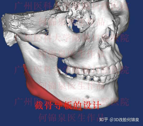 这个病人在3d导板指导下做了下颌角截骨 外板切磨除,效果非常满意.