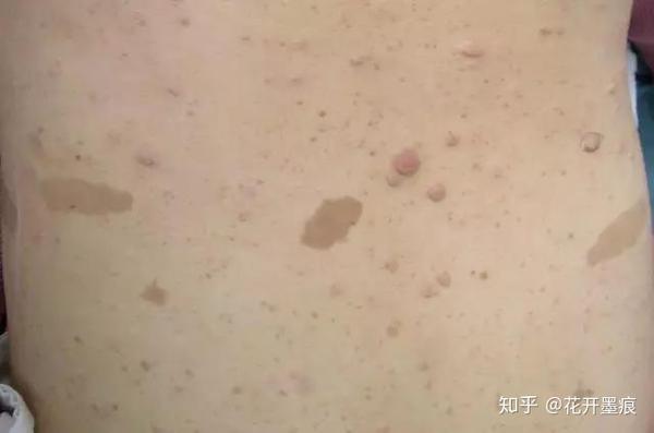 结节性硬化症