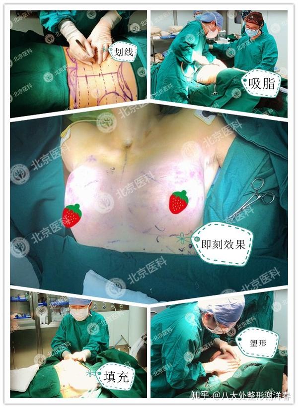自体脂肪丰胸有什么利弊?