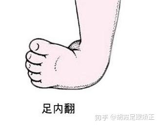 足内翻怎么治疗?