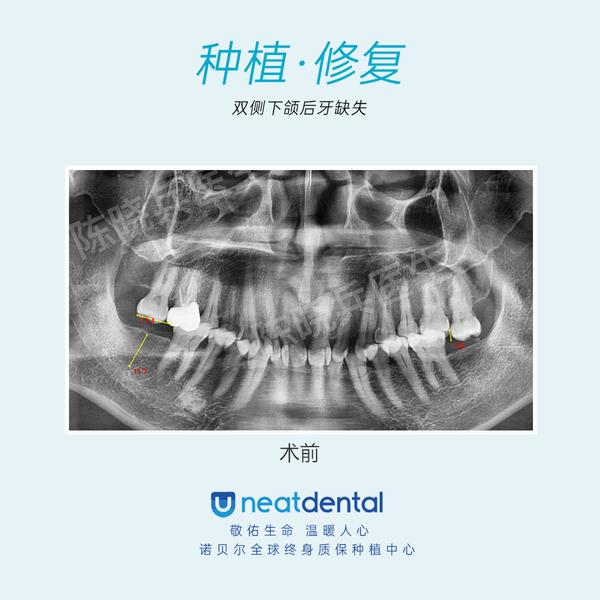 广州牙齿种植广州种植牙缺牙时间长对颌牙伸长还能种牙吗