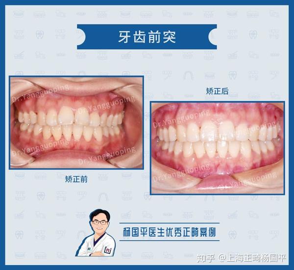 上海舌侧矫正深覆盖牙列拥挤案例分享