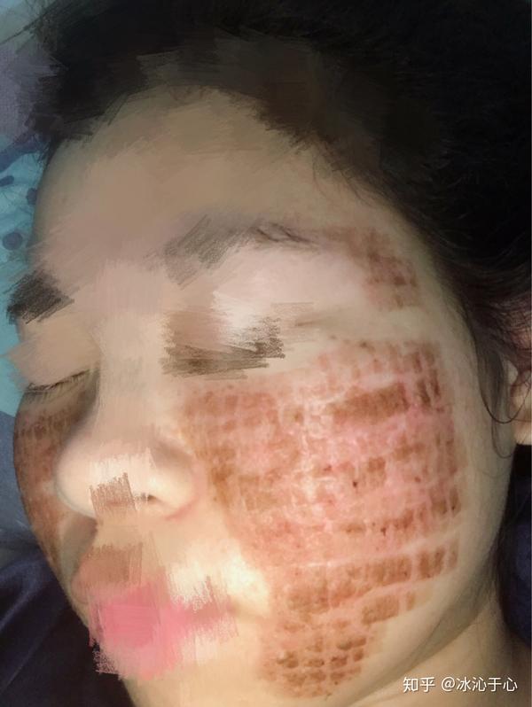 长痤疮留下的痘坑,二氧化碳点阵激光治疗