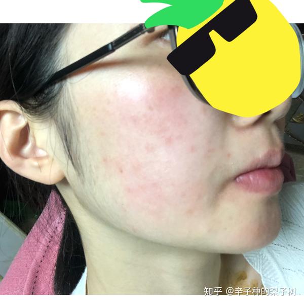 脸上长了很多又红又痒逆光疹子,有些透明的尖头看起来