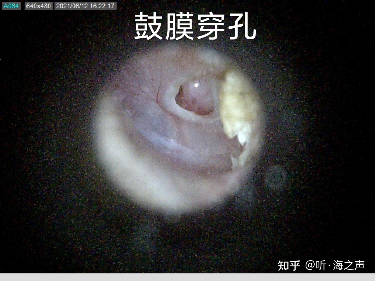 用掏耳勺掏耳朵怎么维持既能掏出耳屎也不会把耳朵戳聋的力度和深度?