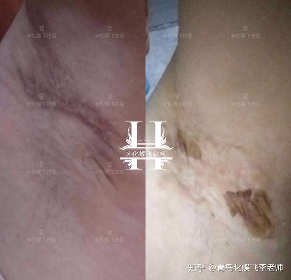 中原郑州,美女做了腋下手术,刀口增生,黏连,色素都挺严重.