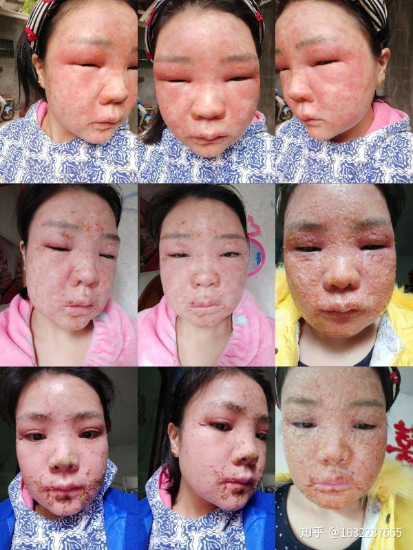 激素性皮炎 脂溢性皮炎 玫瑰痤疮如何区分?资深皮肤管理七老小赖