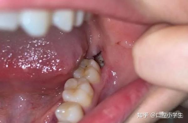 由于种种原因导致窝后2~3天牙槽窝内血凝块分解,破坏,脱落,感染而