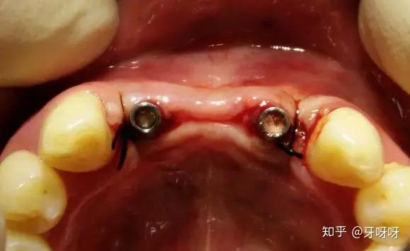 种植体植入ct 感染是种植牙失败的主要原因,若是骨量不够的患者,必须