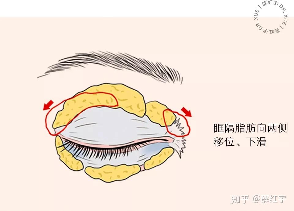 肿泡眼肿眼泡眼部脂肪堆积怎么办