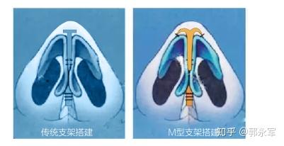 将两侧鼻翼软骨内侧拉拢缝合,通过肋软骨剥离技术拼成双拱支呈m形